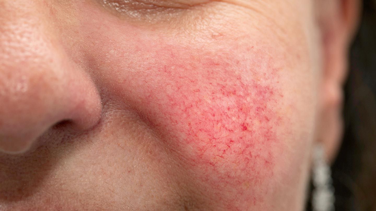 Skin-Conditions-You-Should-Know-About-02-Rosacea-1440x810